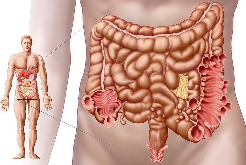diverticulosis-Dr-Miguel-Ángel-Govea-Colorado