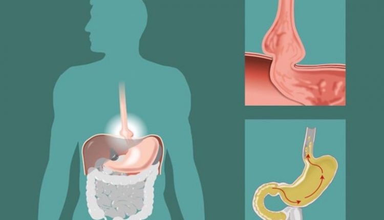 hernia-hiatal-Dr-Miguel-Ángel-Govea-Colorado
