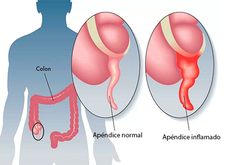 Apendicectomia_Dr_Miguel_Ángel_Govea