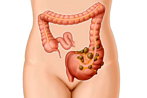 Cirugía_de_diverticulos_Dr_Miguel_Ángel_Govea_Colorado