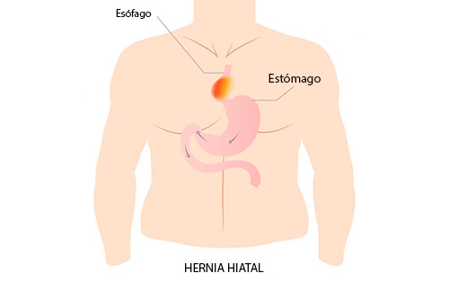 Cirugía_de_hernia_hiatal_Dr_Miguel_Ángel_Govea
