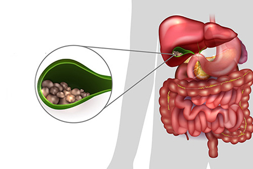 Cirugía_de_vesícula_colecistectomia_Dr_Miguel_Ángel_Govea