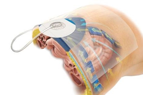 Heridas_de_dificil_cicatrización_Dr_Miguel_Ángel_Govea